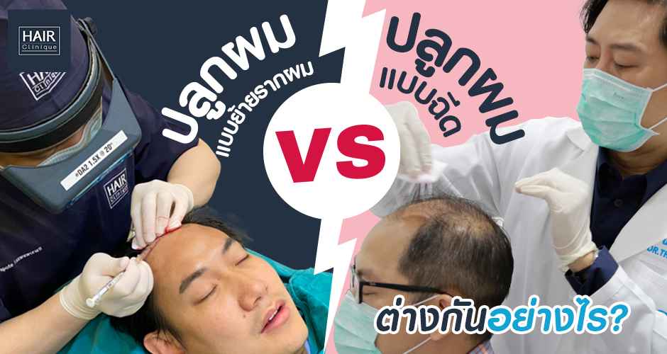 ปลูกผมแบบย้ายรากผม vs ปลูกผมแบบฉีด ต่างกันอย่างไร