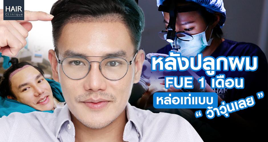 หลังปลูกผม 1 เดือน